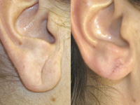 Пластика мочки уха