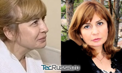 Ирина Агибалова – фото до и после пластических операций