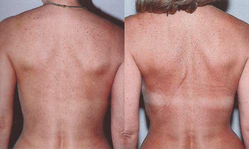 Фото до и после реконструкции молочной железы торакодорсальным лоскутом