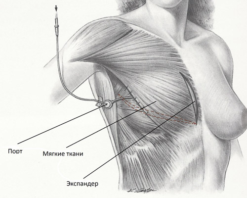 Реконструкция молочной железы с использованием тканевых экспандеров