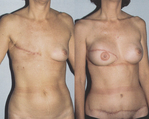 Фото до и после реконструкции молочной железы ректоабдоминальным лоскутом