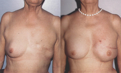 Фото до и после реконструкции молочной железы с использованием тканевых экспандеров