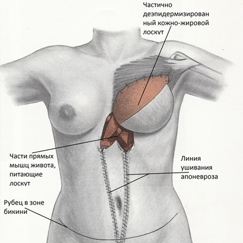Реконструкция молочной железы ректоабдоминальным лоскутом