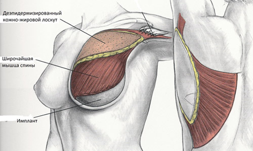 Реконструкция молочной железы торакодорсальным лоскутом