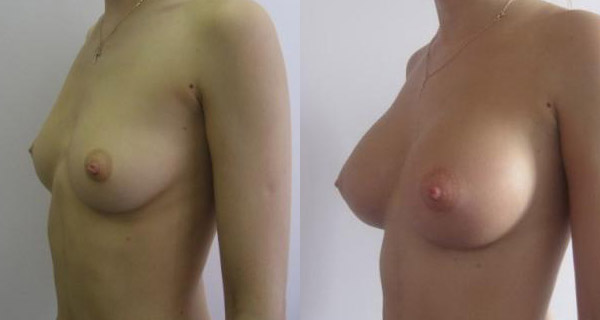 Хирург Фуад Фархат, фото до и после увеличения груди