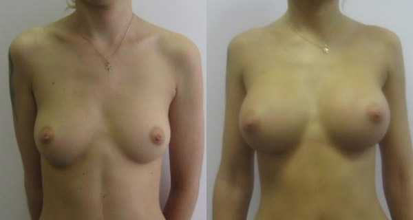 Хирург Фуад Фархат, фото до и после увеличения груди