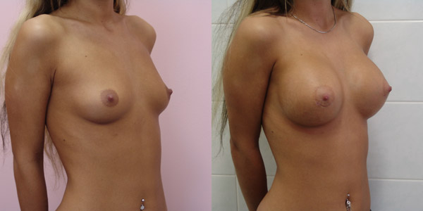 Хирург Балкизов Вячеслав, фото до и после увеличения груди