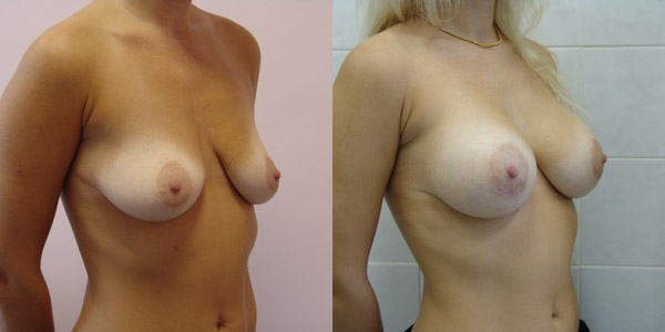 Хирург Балкизов Вячеслав, фото до и после увеличения груди