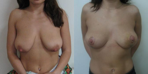 Фото до и после подтяжки груди