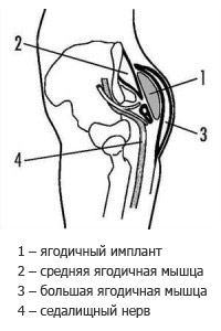 Увеличение ягодиц