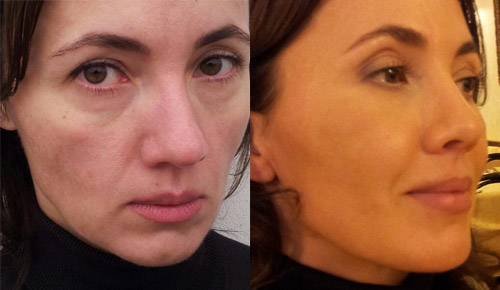 До и через 3 дня после процедуры Face Reshaping