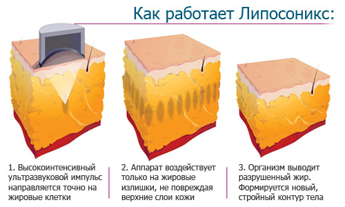 Аппарат Liposonix