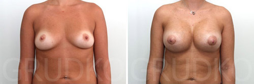До и после увеличения груди у А. Грудько