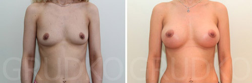 До и после увеличения груди у А. Грудько