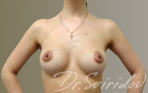 Увеличение груди без швов