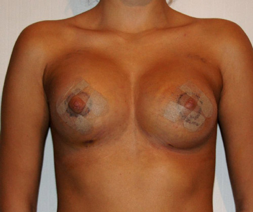 Фото через 3 дня после коррекции дефектов развития груди