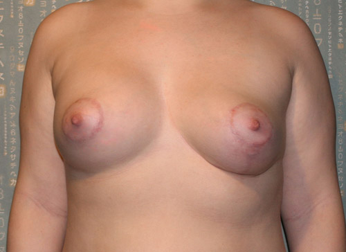 Через 3 месяца после коррекции асимметрии груди