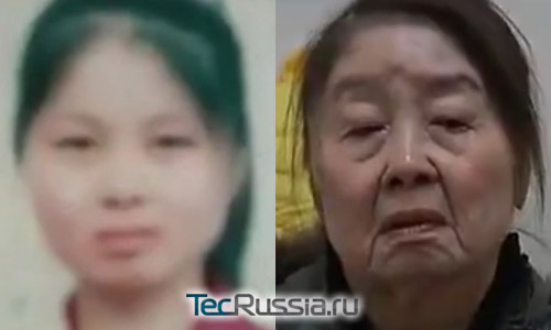 Китаянка Ву до и после заболевания анетодермией
