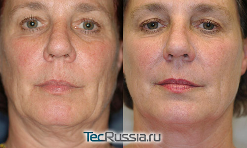 Термаж лица – фото до и после