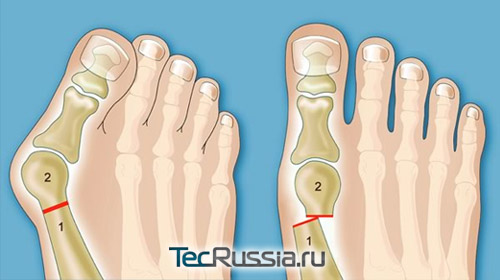 Операция при вальгусной деформации стопы, Hallux valgus