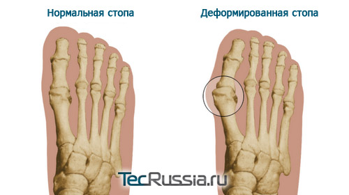 Вальгусная деформация стопы, Hallux valgus