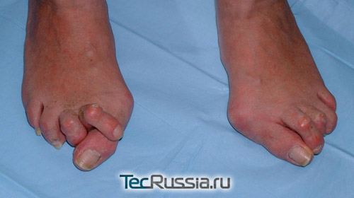 Вальгусная деформация стопы, Hallux valgus