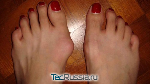 Вальгусная деформация стопы, Hallux valgus