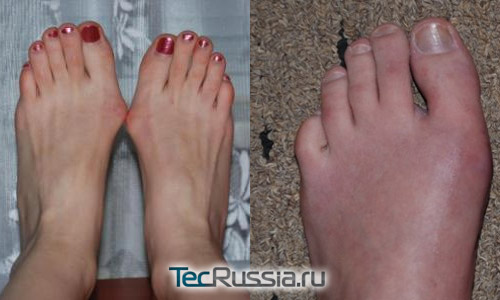 Вальгусная деформация стопы, Hallux valgus