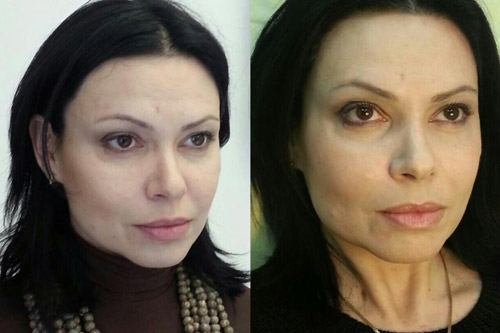 Лиза – фото до и после процедуры Фейс Решейпинг