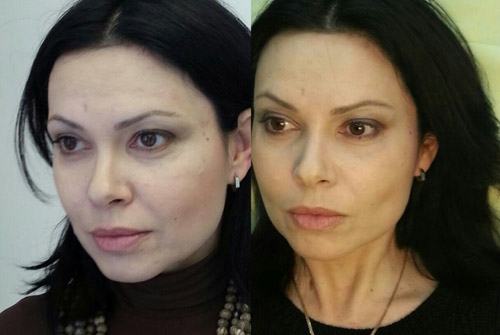 Лиза – фото до и после процедуры Фейс Решейпинг
