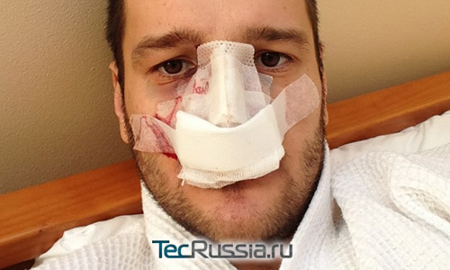 Алексей Самсонов сделал пластическую операцию