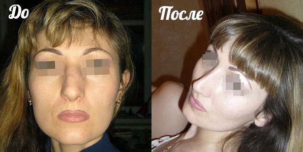 Пример восстановления эстетичной формы носа после недовыполненной ринопластики