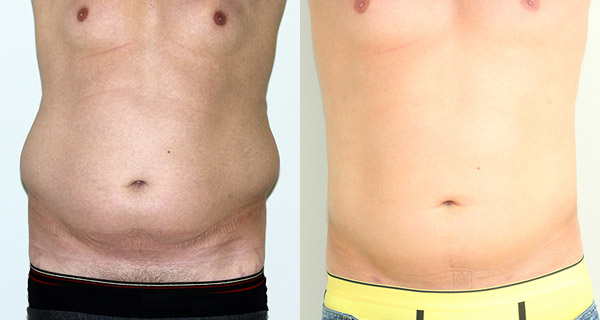 Фото до и после лазерной липосакции (мужчина)