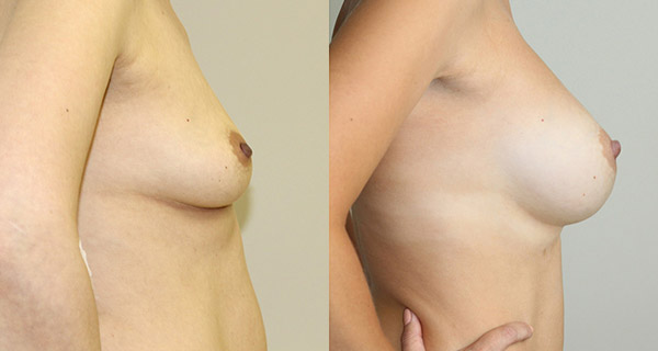 увеличение груди, фото до и после операции