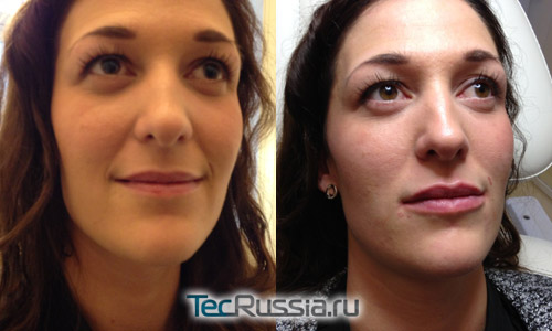 Фото до и после инъекций Juvederm Volbella 