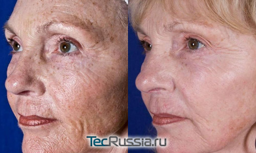 Фото до и после лечения фотостарения