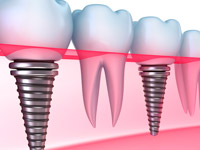 9 мифов о зубных имплантах