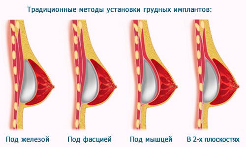 Традиционные методы установки грудных имплантов