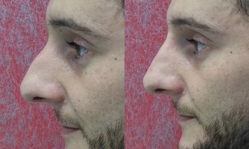 До и после безоперационной коррекции носа у д-ра Мерлина