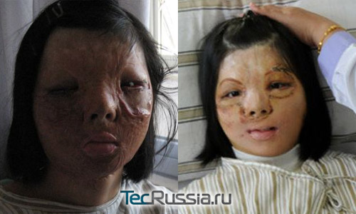 Фото Сюй до и после пересадки лица