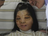 Китайские врачи вырастили лицо на груди 17-летней пациентки