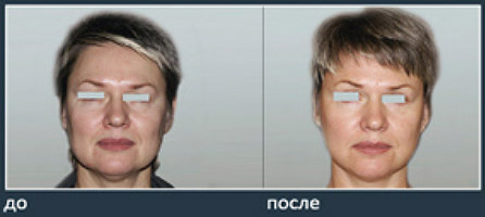 До и после пластики лица, хирург Салиджанов А.Ш.