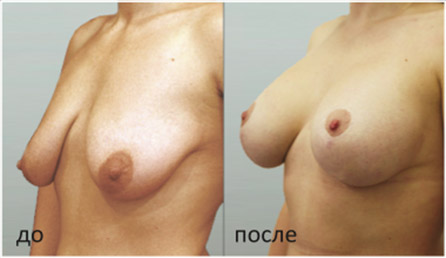 До и после пластики груди, хирург Салиджанов А.Ш.