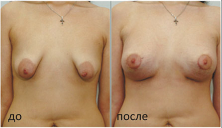 До и после коррекции тубулярной груди, хирург Салиджанов А.Ш.