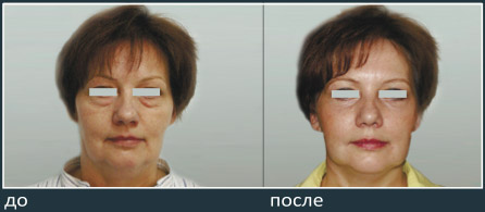 До и после пластики лица, хирург Салиджанов А.Ш.