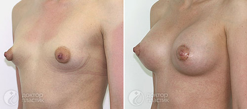 Результат увеличения груди с одновременной коррекцией ареол