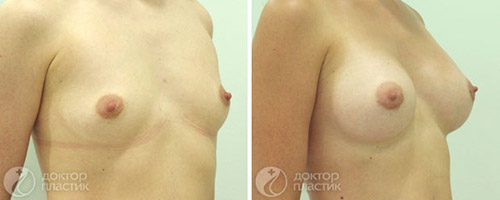 Увеличение груди, анатомические импланты – фото