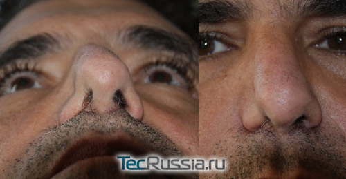 Перфорация носовой перегородки после неудачной ринопластики