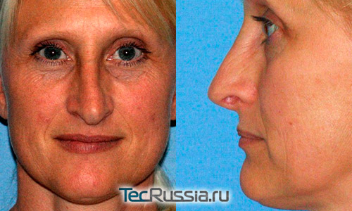 Деформация носа после – осложнение после неудачной ринопластики