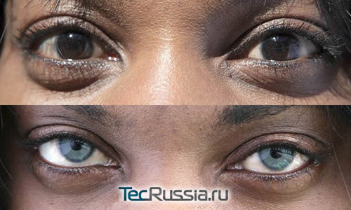 операция по смене цвета глаз с помощью имплантов Bright Ocular – фото до и после